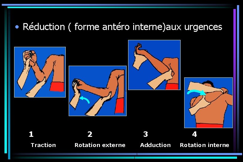  • Réduction ( forme antéro interne)aux urgences 1 Traction 2 Rotation externe 3