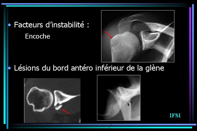  • Facteurs d’instabilité : Encoche • Lésions du bord antéro inférieur de la