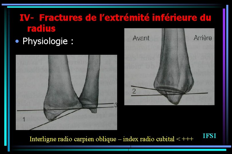 IV- Fractures de l’extrémité inférieure du radius • Physiologie : Interligne radio carpien oblique