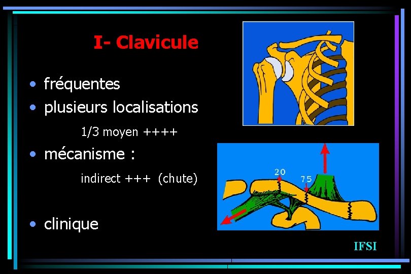 I- Clavicule • fréquentes • plusieurs localisations 1/3 moyen ++++ • mécanisme : indirect