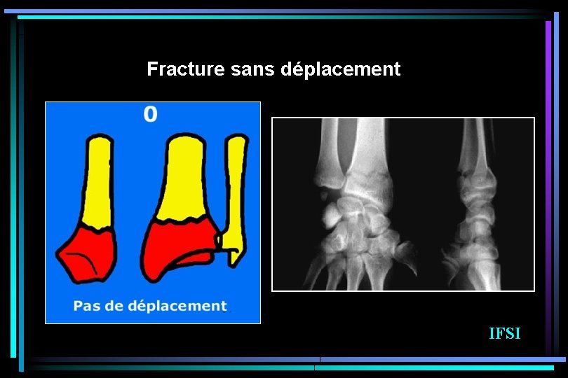 Fracture sans déplacement IFSI 