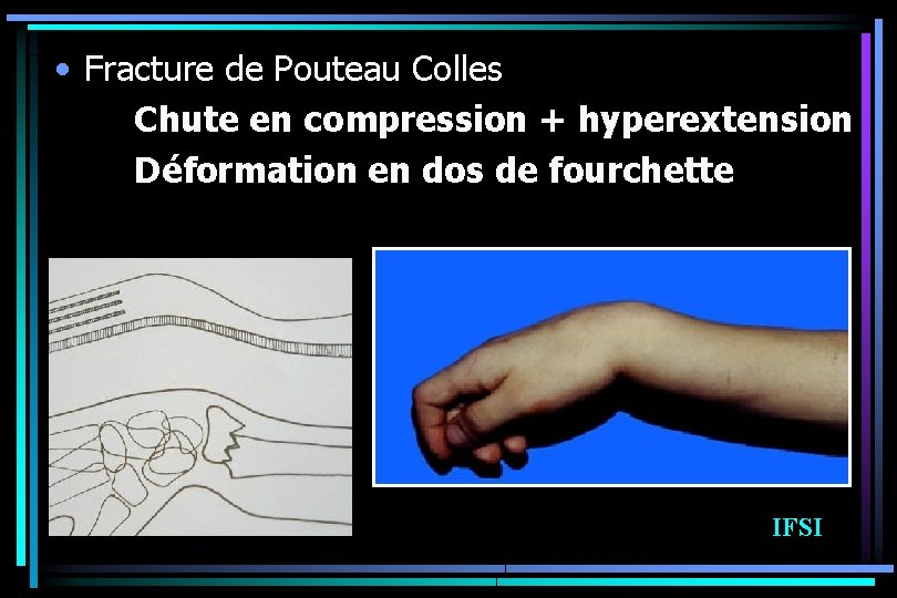  • Fracture de Pouteau Colles Chute en compression + hyperextension Déformation en dos