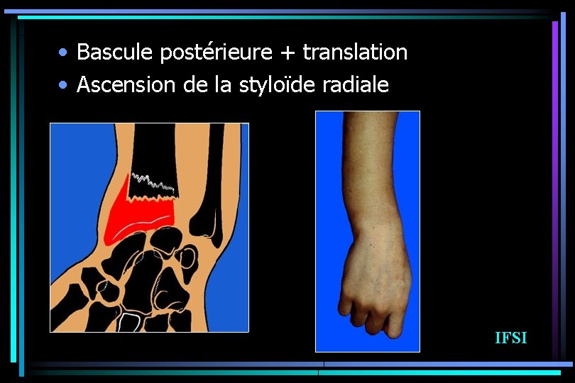  • Bascule postérieure + translation • Ascension de la styloïde radiale IFSI 