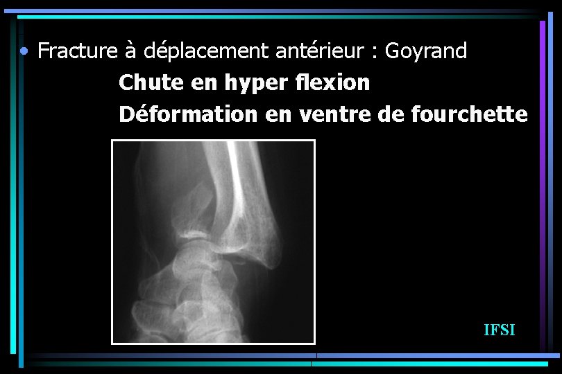  • Fracture à déplacement antérieur : Goyrand Chute en hyper flexion Déformation en