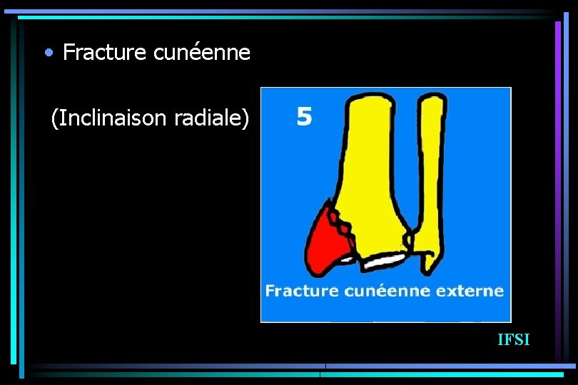  • Fracture cunéenne (Inclinaison radiale) IFSI 