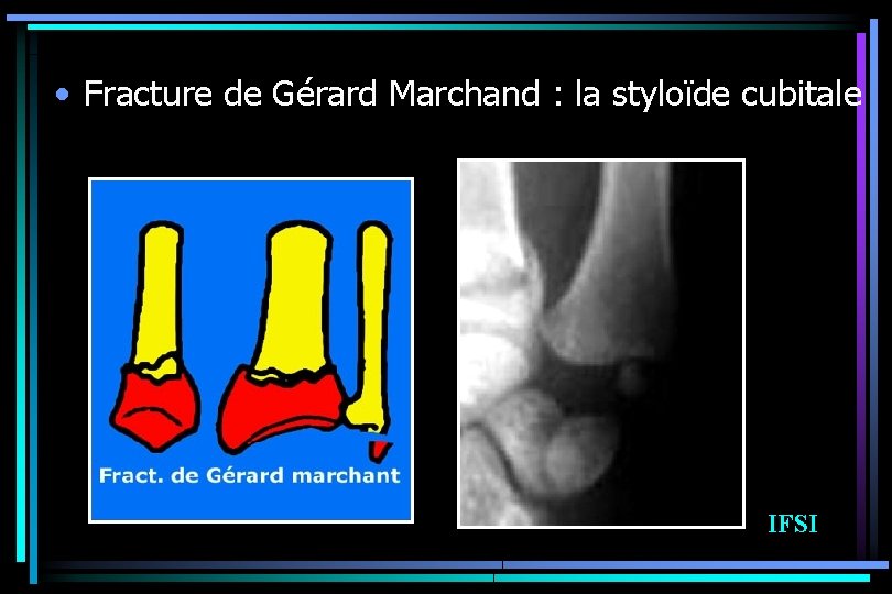  • Fracture de Gérard Marchand : la styloïde cubitale IFSI 