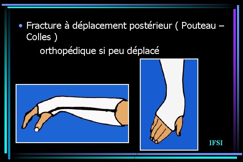  • Fracture à déplacement postérieur ( Pouteau – Colles ) orthopédique si peu