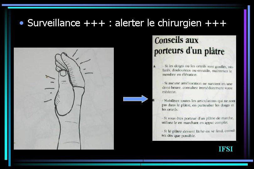  • Surveillance +++ : alerter le chirurgien +++ IFSI 