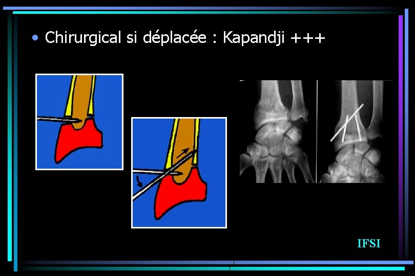  • Chirurgical si déplacée : Kapandji +++ IFSI 