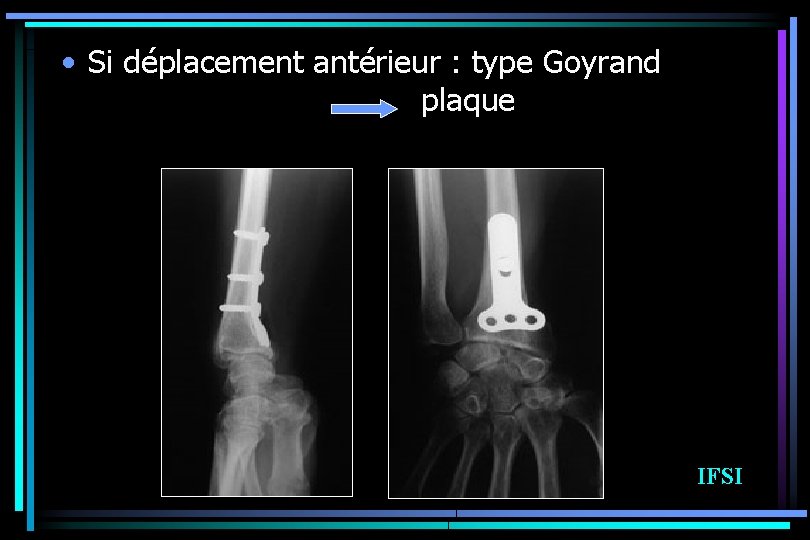  • Si déplacement antérieur : type Goyrand plaque IFSI 