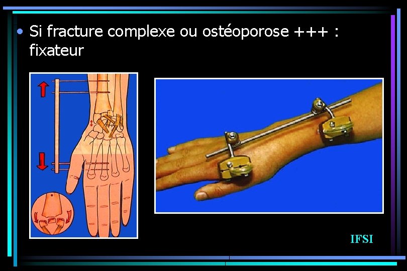  • Si fracture complexe ou ostéoporose +++ : fixateur IFSI 