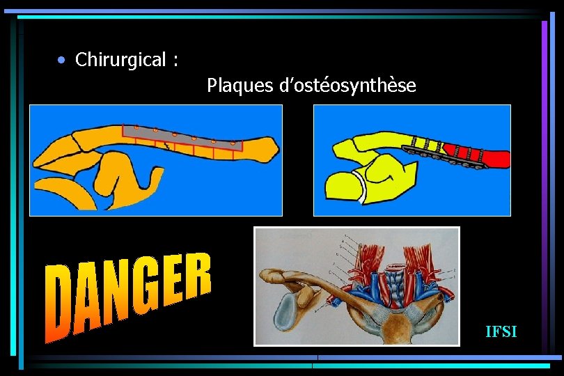  • Chirurgical : Plaques d’ostéosynthèse IFSI 