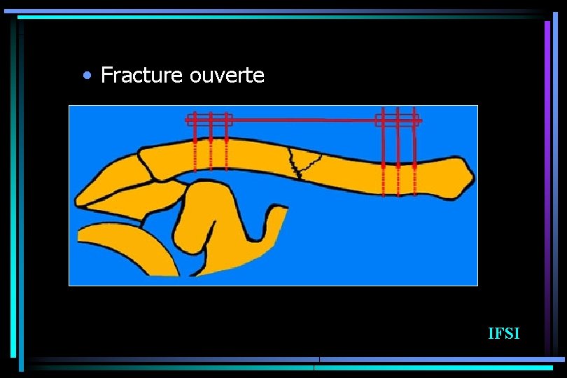  • Fracture ouverte IFSI 