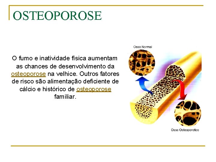 OSTEOPOROSE O fumo e inatividade física aumentam as chances de desenvolvimento da osteoporose na