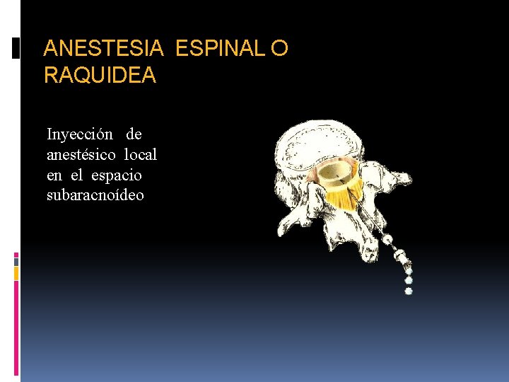 ANESTESIA ESPINAL O RAQUIDEA Inyección de anestésico local en el espacio subaracnoídeo 