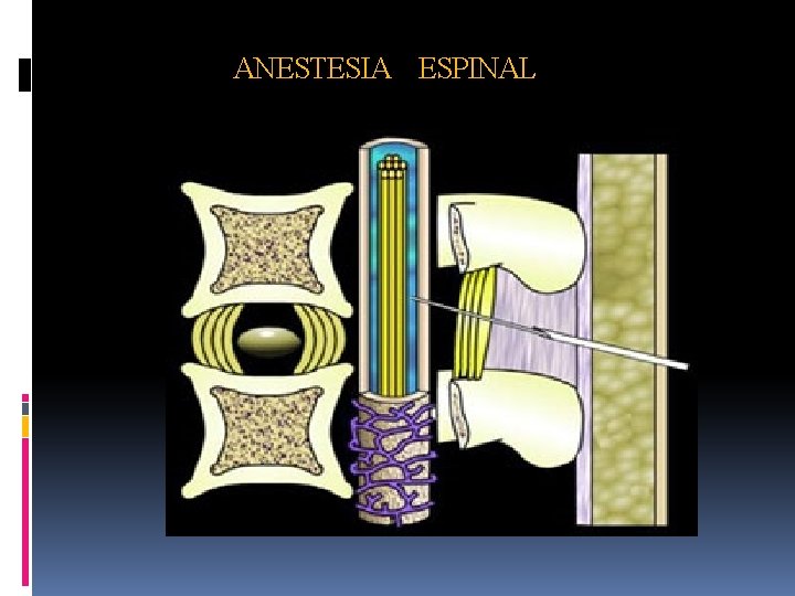 ANESTESIA ESPINAL 