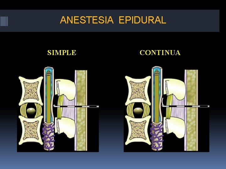 ANESTESIA EPIDURAL SIMPLE CONTINUA 