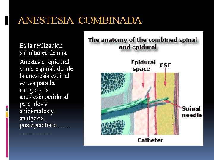 ANESTESIA COMBINADA Es la realización simultánea de una Anestesia epidural y una espinal, donde