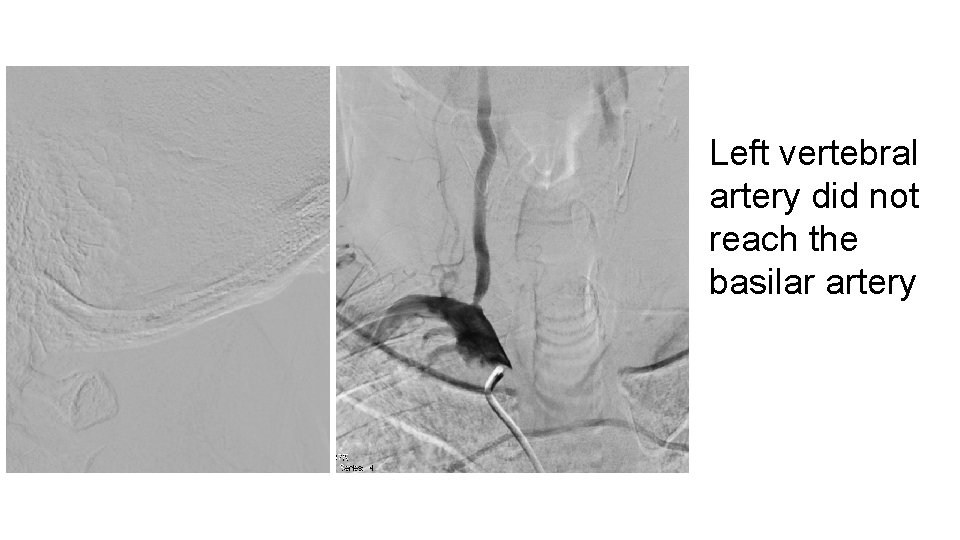 Left vertebral artery did not reach the basilar artery 