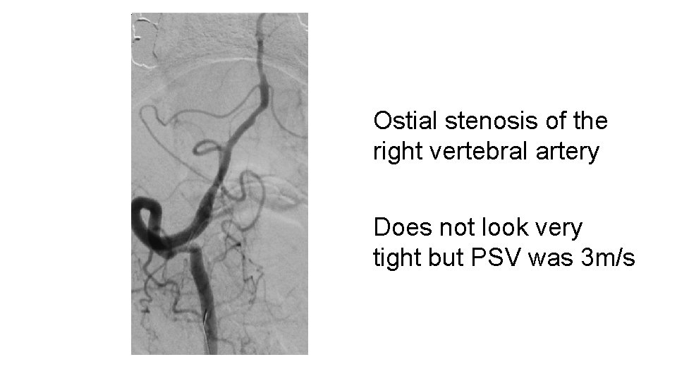 Ostial stenosis of the right vertebral artery Does not look very tight but PSV