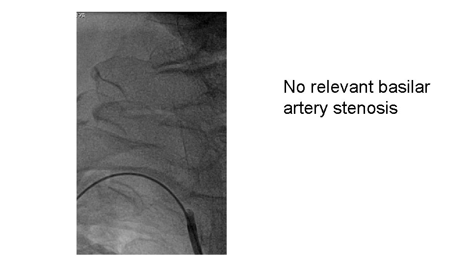 No relevant basilar artery stenosis 