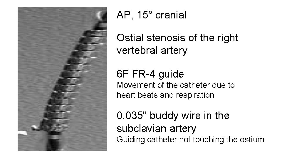 AP, 15° cranial Ostial stenosis of the right vertebral artery 6 F FR-4 guide