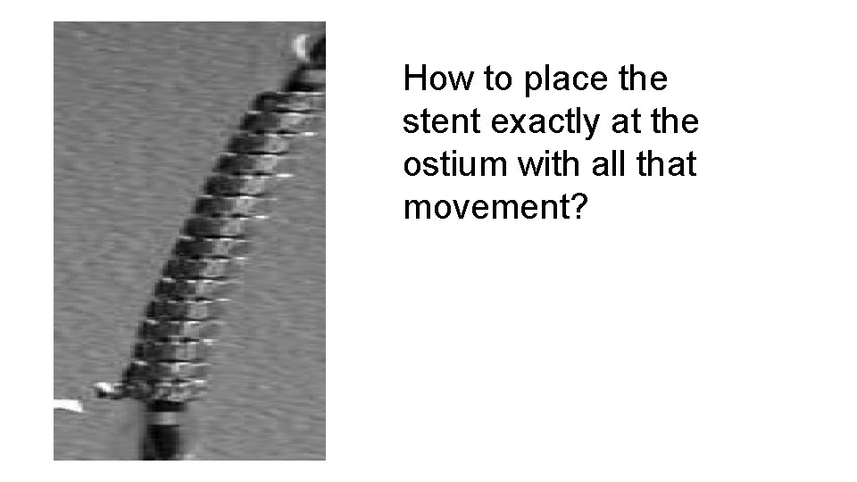 How to place the stent exactly at the ostium with all that movement? 
