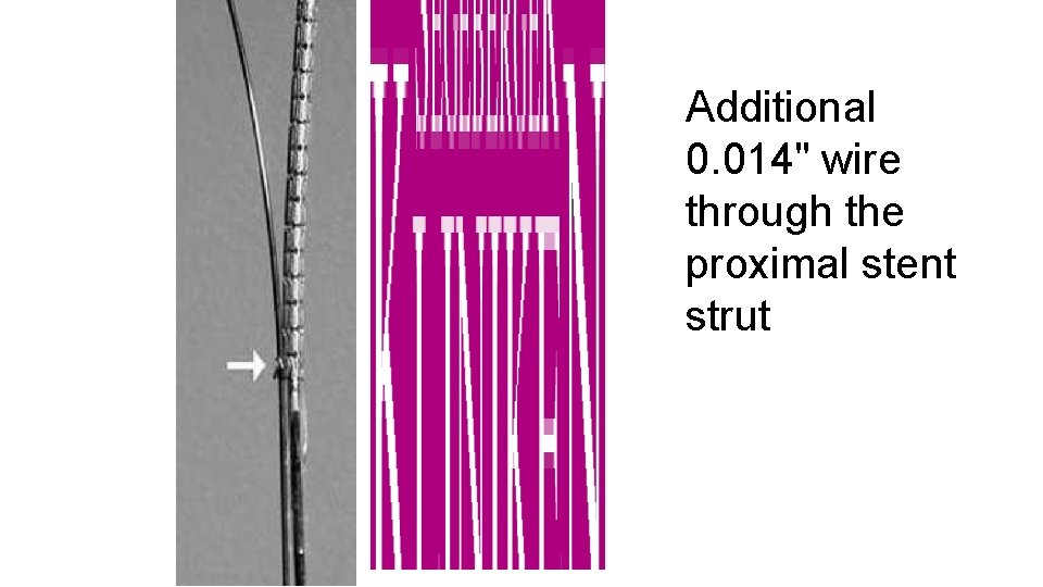 Additional 0. 014" wire through the proximal stent strut 