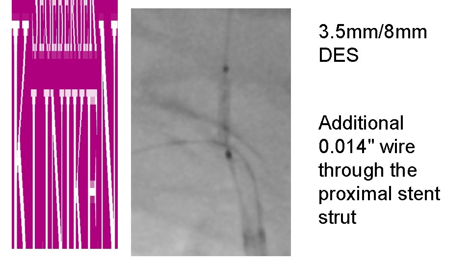 3. 5 mm/8 mm DES Additional 0. 014" wire through the proximal stent strut