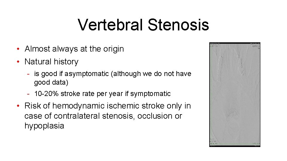 Vertebral Stenosis • Almost always at the origin • Natural history - is good