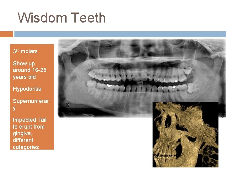 Wisdom Teeth 3 rd molars Show up around 16 -25 years old Hypodontia Supernumerar