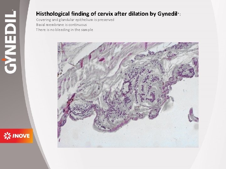Histhological finding of cervix after dilation by Gynedil Covering and glandular epithelium is preserved