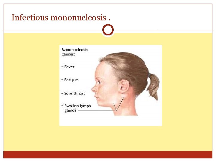 Infectious mononucleosis. 