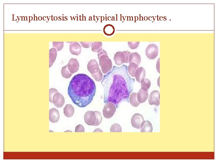 Lymphocytosis with atypical lymphocytes. 