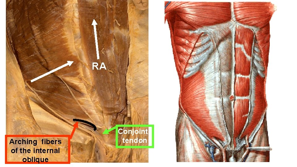 RA Arching fibers of the internal oblique Conjoint tendon 