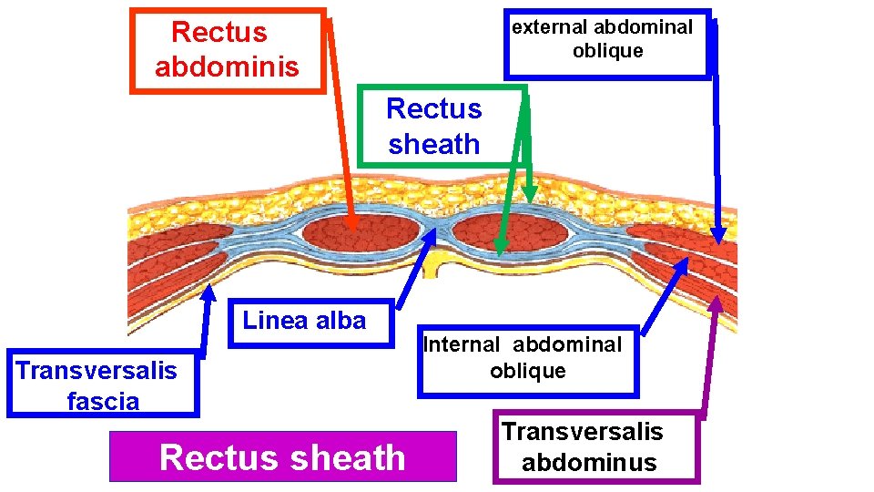 Rectus abdominis external abdominal oblique Rectus sheath Linea alba Transversalis fascia Rectus sheath Internal