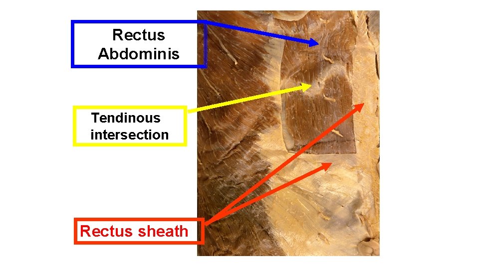 Rectus Abdominis Tendinous intersection Rectus sheath 