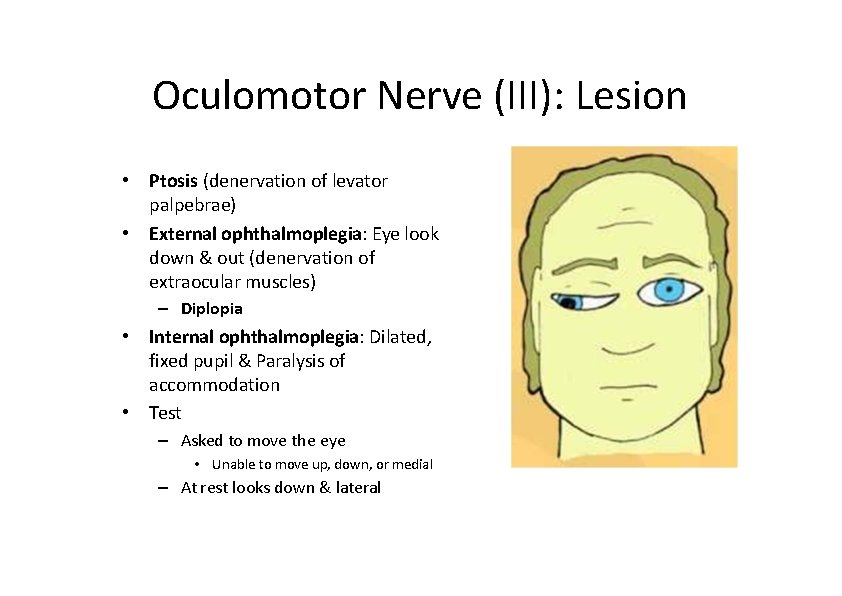 Oculomotor Nerve (III): Lesion • Ptosis (denervation of levator palpebrae) • External ophthalmoplegia: Eye