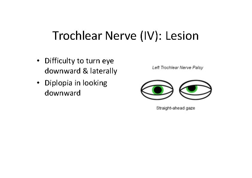Trochlear Nerve (IV): Lesion • Difficulty to turn eye downward & laterally • Diplopia