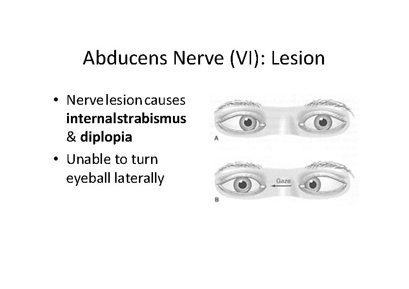Abducens Nerve (VI): Lesion • Nerve lesion causes internal strabismus & diplopia • Unable