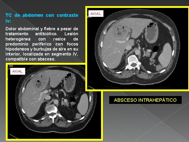 TC de abdomen contraste iv: AXIAL Dolor abdominal y fiebre a pesar de tratamiento