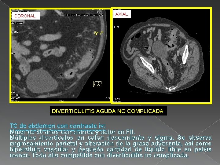 CORONAL AXIAL DIVERTICULITIS AGUDA NO COMPLICADA TC de abdomen contraste iv: Mujer de 80