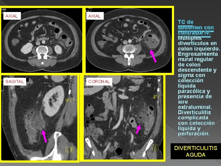AXIAL SAGITAL AXIAL CORONAL TC de abdomen contraste iv: Múltiples divertículos en colon izquierdo.