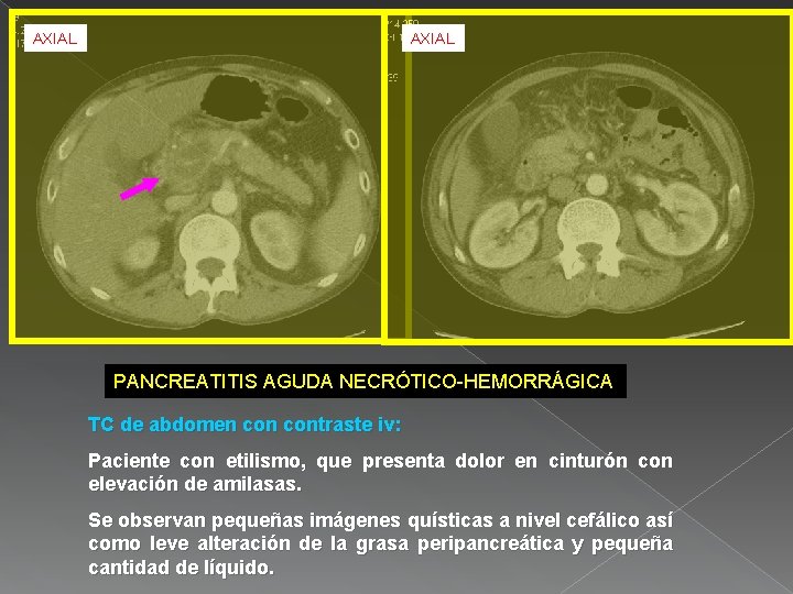 AXIAL PANCREATITIS AGUDA NECRÓTICO-HEMORRÁGICA TC de abdomen contraste iv: Paciente con etilismo, que presenta