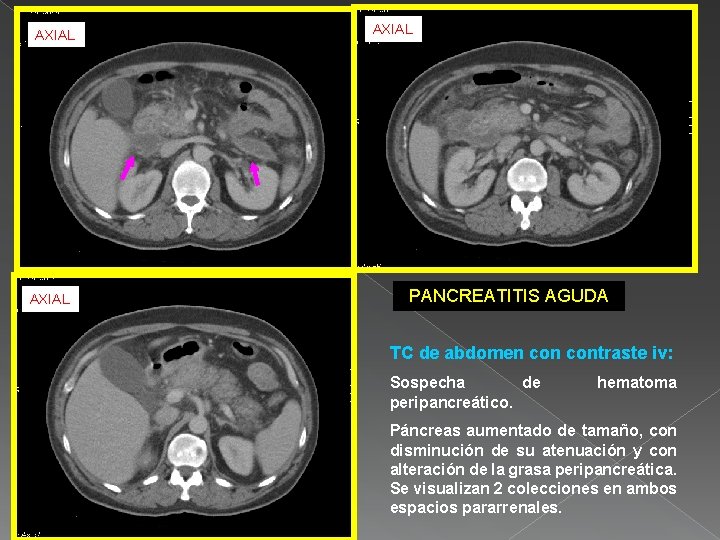AXIAL PANCREATITIS AGUDA TC de abdomen contraste iv: Sospecha de peripancreático. hematoma Páncreas aumentado