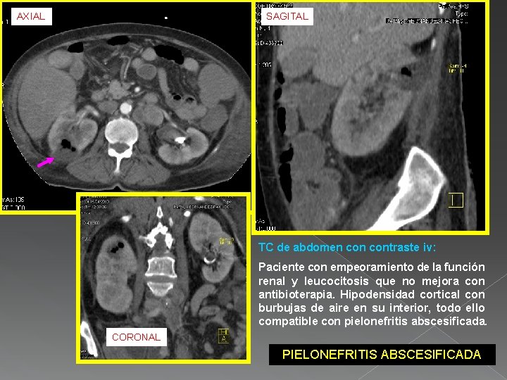 AXIAL SAGITAL TC de abdomen contraste iv: Paciente con empeoramiento de la función renal