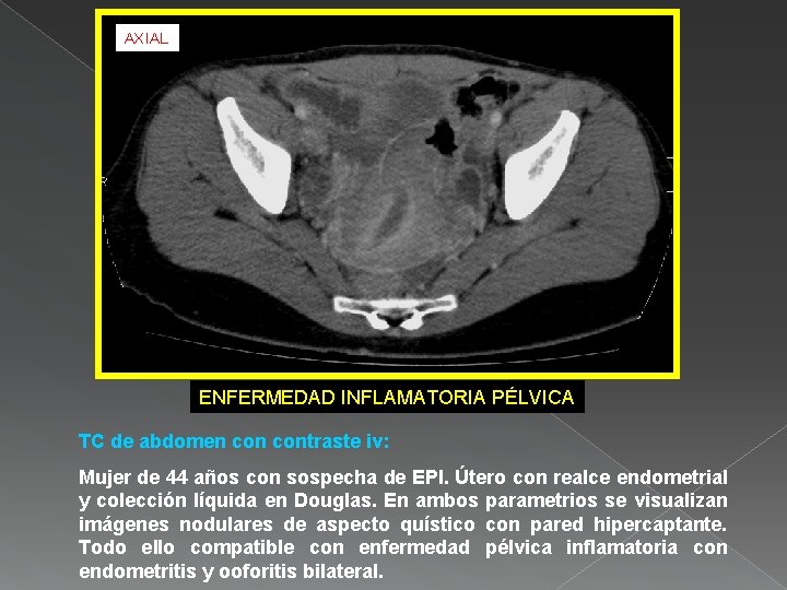 AXIAL ENFERMEDAD INFLAMATORIA PÉLVICA TC de abdomen contraste iv: Mujer de 44 años con