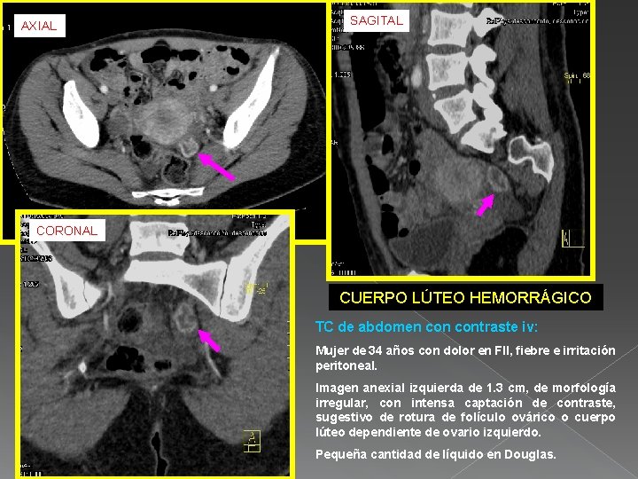AXIAL SAGITAL CORONAL CUERPO LÚTEO HEMORRÁGICO TC de abdomen contraste iv: Mujer de 34