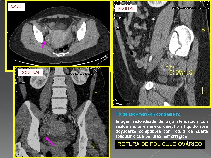 AXIAL SAGITAL CORONAL TC de abdomen contraste iv: Imagen redondeada de baja atenuación con