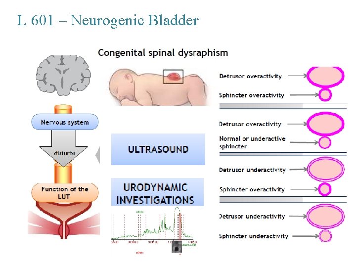 L 601 – Neurogenic Bladder 